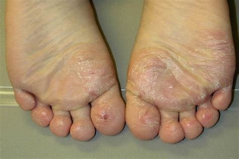 dermatite no pé